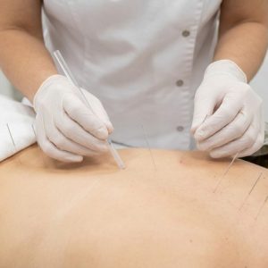 Terapia alternativa y acupuntura